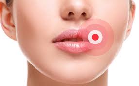 Ich weiss nicht, ob es wirklich pickel sind. Lippen Pickel Pickel An Der Lippe Ursachen Und Behandlung 2020 01 19