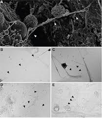 Furthermore, p16 deletions were specifically detected by fluorescence in situ hybridization, and electron microscopy showed numerous, . Tnt Tethering Of Mesothelioma Cells In In Vitro Models Of Pleural Download Scientific Diagram
