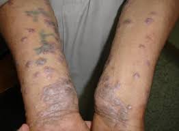 Lichen planus is an inflammatory immune system issue of your skin or mucous membranes. Lichen Planus Causes What It Looks Like How To Get Rid Of It