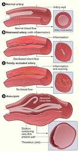 Image result for Vasculitis