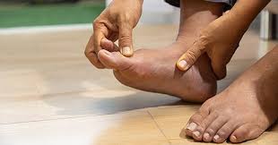 Image result for gout symptoms toe