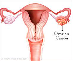 Can a blood test detect ovarian cancer. New Blood Test Can Soon Detect Ovarian Cancer Early