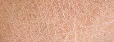 Image result for Dry Skin