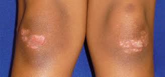 Image result for psoriasis