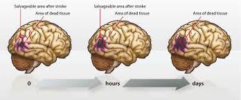 Cerebral stroke refers to a problem arising due to lack of oxygen supply to the brain. Time Is Brain Emergency Treatment Of Stroke Bpj 26 March 2010
