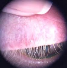 Image result for demodex rosacea