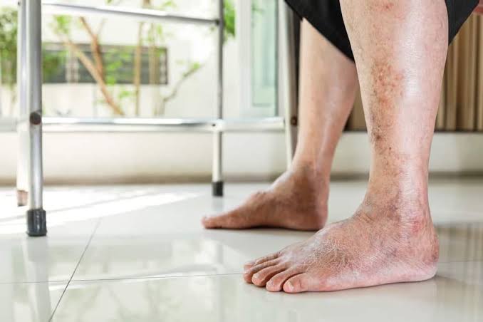 Hướng dẫn cách chăm sóc da cho người bị tiểu đường