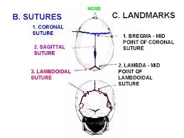 A fairly rigid joint between two or more hard elements, such as the bony plates of the skull. Skull Session Bones Rigidly Connected By Sutures To