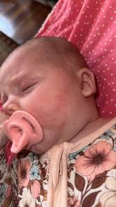 Treatment for Molluscum contagiosum with Skin Virus Drops