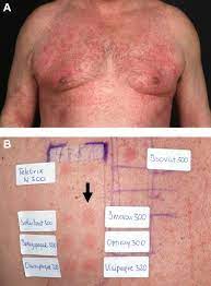 Adverse Reactions During Procedures Annals Of Allergy Asthma Immunology