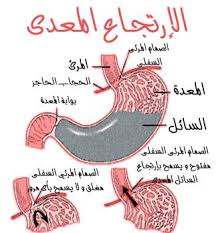 عيادة الدكتور احمد عبد العزيز للجراحة العامه والأورام والمناظير أهم ما يجب معرفته عن ارتجاع المرئ اسبابه وعلاجه ربما اثناء منتصف الليل تستيقظ بسبب السعال والاختناق أو ربما كنت في العمل