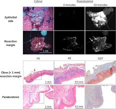 If you've had a biopsy, your tumor is small (under 4 cm), and your surgical margins are clear, a lumpectomy may be all the breast surgery you need. Detecting Tumour Positive Resection Margins After Oral Cancer Surgery By Spraying A Fluorescent Tracer Activated By Gamma Glutamyltranspeptidase Sciencedirect