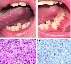 Image result for granuloma gum disease