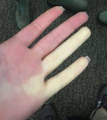 Raynaud Syndrome Wikipedia