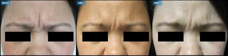 How long does botox take to work? Botox Dysport Injections In Burbank Ca Wrinkle Reduction Northridge