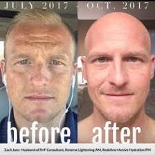After testing countless bleaching creams, we agree with divine derriere's claim of having one of the strongest dark spot correctors without a prescription. Bikini Area Skin Bleaching