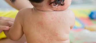 What To Know About Hand Foot And Mouth Disease