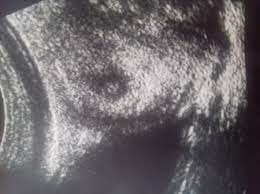 Hamilelikte cinsiyet ne zaman belli olur? Kizlar Cinsiyet Tahmini Yapalim Mi Hamilelikte Bebek Sagligi