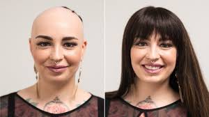 It may happen on any part of the body. Real Hair Wig Instead Of Baldness Help With Alopecia Areata Hairsystems Heydecke Youtube