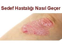 Sedef Hastaligi Vucudun Diz Dirsek Kafatasi Gibi Belli Basli Bolgelerinde Pullanma Kizariklik Enf Essential Oils For Psoriasis Psoriasis Remedies Psoriasis