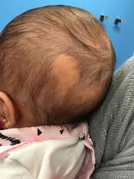 Basal cell carcinoma is the most common form of skin cancer, and least dangerous whereas melanoma (often referred to as. Nevus Sebaceous Pediatric And Adult Plastic Surgery Dr Bastidas