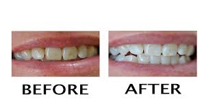 We did not find results for: How To Remove Coffee Stains From Teeth Teethwalls