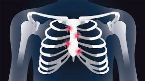 Many broken ribs are merely cracked. Rheumatoid Arthritis Chest And Rib Pain What Is Costochondritis Everydayhealth