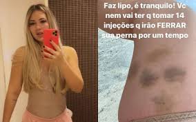 Maria alice, primeira filha do sertanejo zé felipe e da influenciadora digital virgínia fonseca nasceu na manhã deste domingo, 30. Virginia Fonseca Impressiona Com Roxos Na Perna Apos Lipo Lad 14 Injecoes Quem Quem News