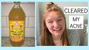 Apple Cider Vinegar Cleared My Acne Grace Jennings Youtube