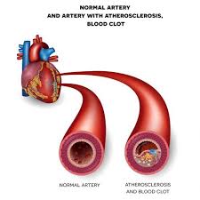 A blood clot often forms in arteries damaged by the buildup of plaques (atherosclerosis). What Happens When You Have A Blocked Artery In Your Arm Cardiac Screen
