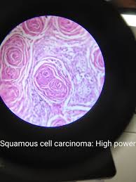 A pitfall in the diagnosis of ameloblastic carcinoma ankita baldwa, rashmi krishnappa, aarathi rau, usha muniyappa, g girish department of pathology and surgical oncology, m.s. Keratin Pearls Squamous Cell Squamous Cell Carcinoma Squamous