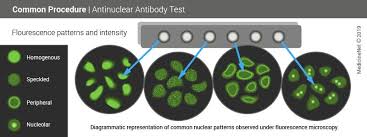 Antinuclear Antibody Test Normal Range Interpretation