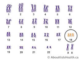 Trisomy 18 Edwards Syndrome