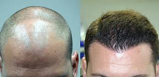 Luca cravero chirurgo plastico fut fue. Trapianto Capelli Pordenone Come Ottenere Risultati Veri Hairclinic