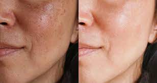 Below, we share additional tips to follow to help reduce the appearance an uneven. How To Even Skin Tone 4 Uneven Skin Tips L Oreal Paris