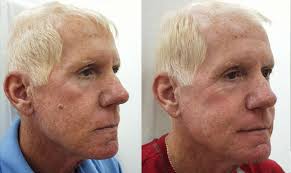 For skin cancers with a high risk of spreading, surgery sometimes will be … Aventura Beach Mole Removal Treatment Fort Lauderdale Skin Cancer