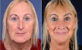Not all transgender people transition, and transitions look different for all kinds of people. Facial Feminization Surgery Before And After Picture Facial Feminization Surgery Facial Feminism