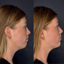 Main reason I wanted to contact you guys is that I'm having an event this  Friday 5/20 all day where we are offering Restylane for $350/ syringe. We  have another doctor Dr.