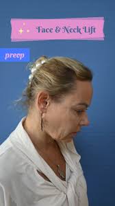 عملية شد الوجه والرقبه قبل وبعد يومين من الجراحه. , Face and neck lifting,  2 days after the symptoms. Thanks for my patient agreeing posting her  pictures and videos 🙏