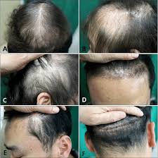 You can get treatment for your sebaceous cyst a healthcare provider may drain a cyst that is large, tender, or inflamed. Case 1 Some Diffuse Hair Loss Especially In The A Frontal And B Download Scientific Diagram