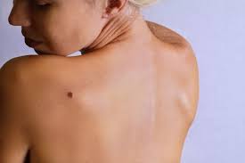 If you have skin cancer, it is important to know which type you have because it affects your treatment options and your outlook (prognosis). Ask The Expert Painful Moles The Skin Cancer Foundation