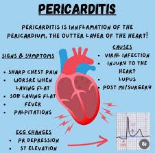 Image result for Pericarditis