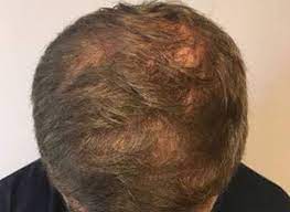 No longer do you have to spend time pencilling in your eyebrows, because ahti can have them growing in the shape, angle and direction you desire. Hair Transplant Michigan Michigan Hair Restoration Dr Berkowitz