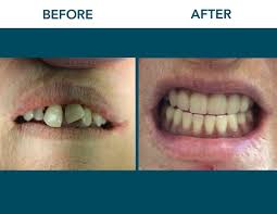 We did not find results for: Before After Photos Dentist Mobile Al Springhill Theodore Saraland Chickasaw