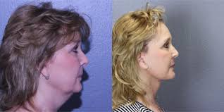 John A. Standefer Jr., MD, FACS, Board Certified Facial Plastic Surgeon