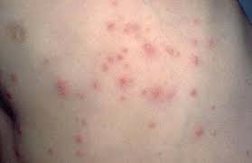 Image result for penis mycosis symptoms