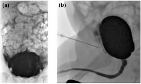 Image result for Voiding Cystourethrogram