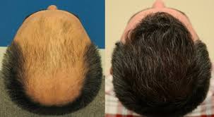 Avodart results vary from person to person, however it does work. Dutasteride And Hair Loss Hairsite Com