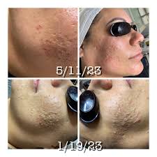 Reviews of Clear Beauty Acne Clinic