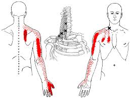 Trigger points and myofascial pain: What Is A Trigger Point Indy Spine And Rehab